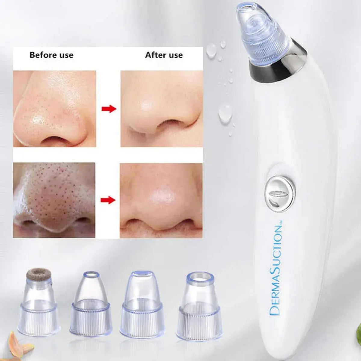 ✨ Derma Suction 4-in-1 Blackhead Remover | Deep Pore Vacuum SwagAura